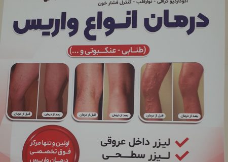 اولین و تنها مرکز فوق تخصصی درمان واریس در خوی ( آذربایجان غربی) توسط دکتر احمد احمد زاده